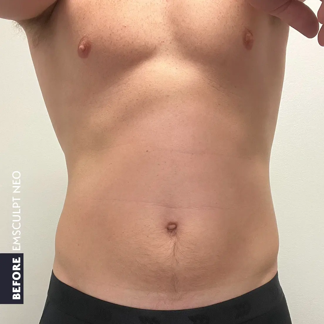 Front view of a patient's abdomen before EMSCULPT NEO treatment