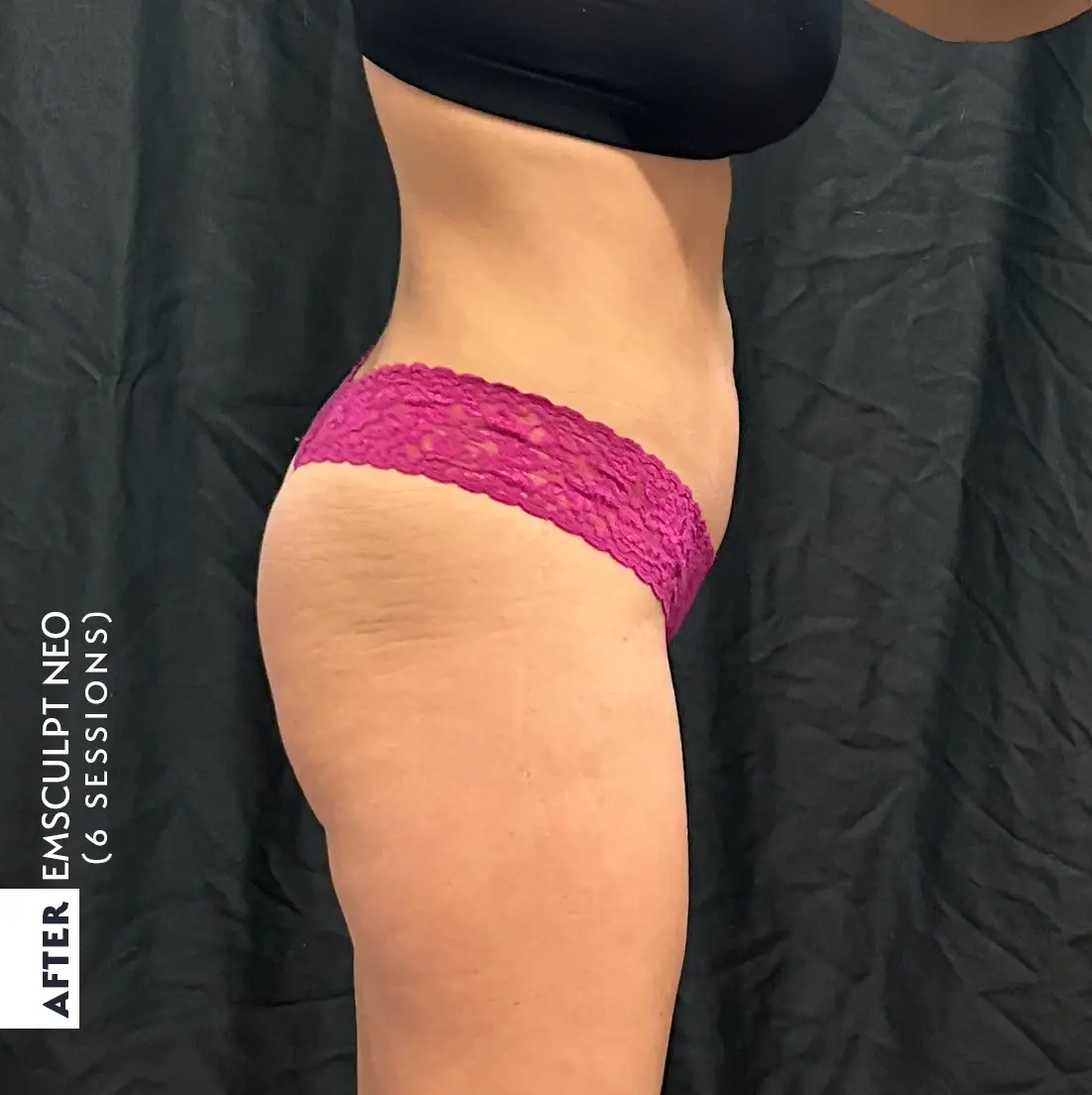 The same patient's hip and buttock after six EMSCULPT NEO sessions