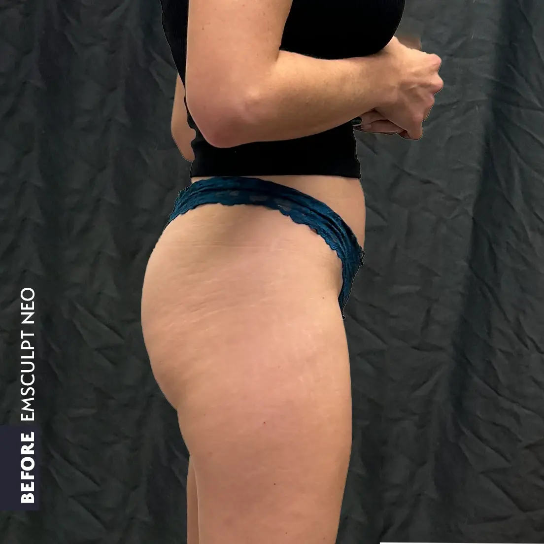 Side view of a patient's hip and buttock before EMSCULPT NEO treatment