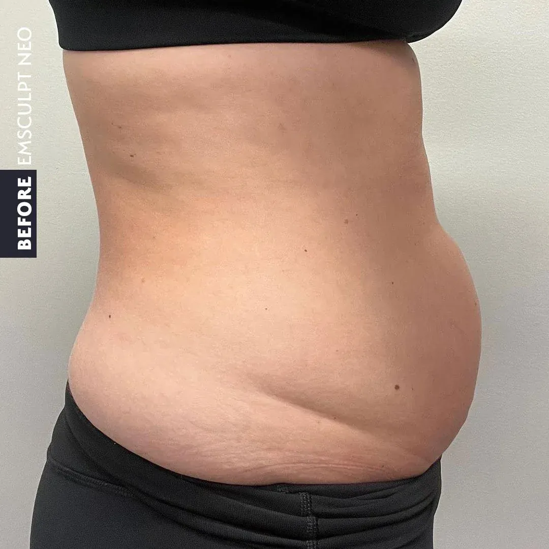 BEFORE EMSculpt NEO