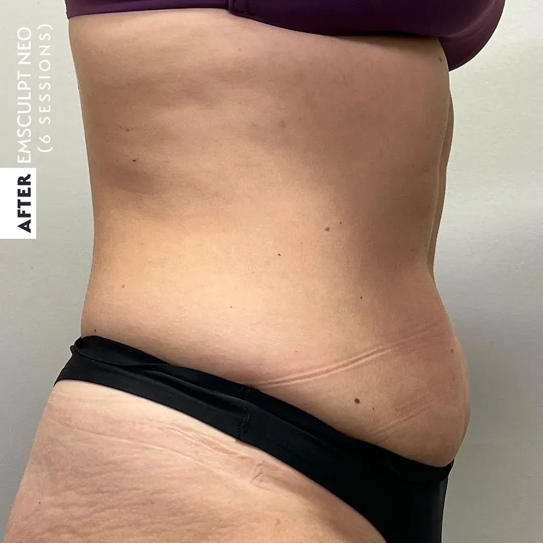 AFTER EMSculpt NEO (6 sessions)